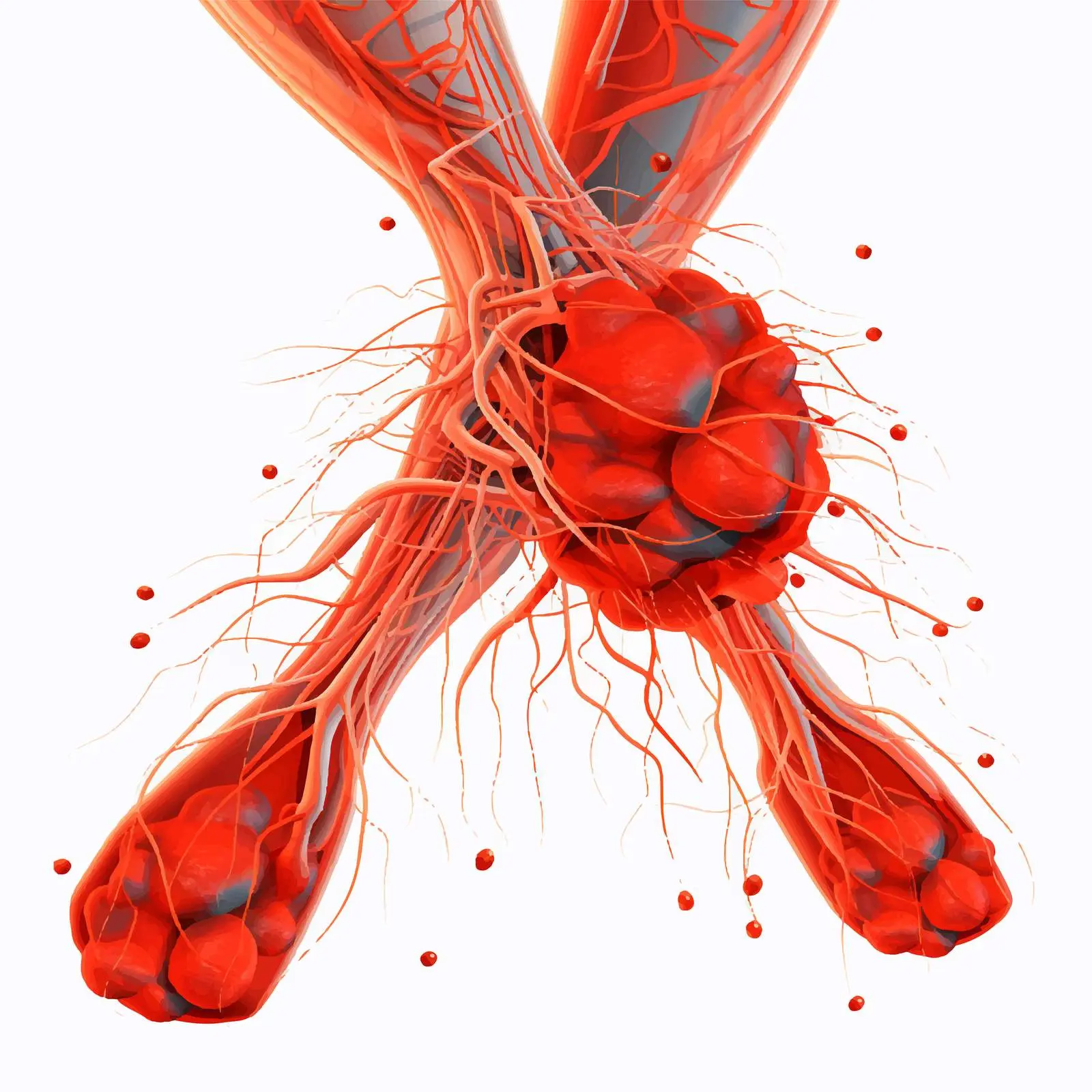 Illustration of Deep Vein Thrombosis in Human Legs – free blood image from Dotvec