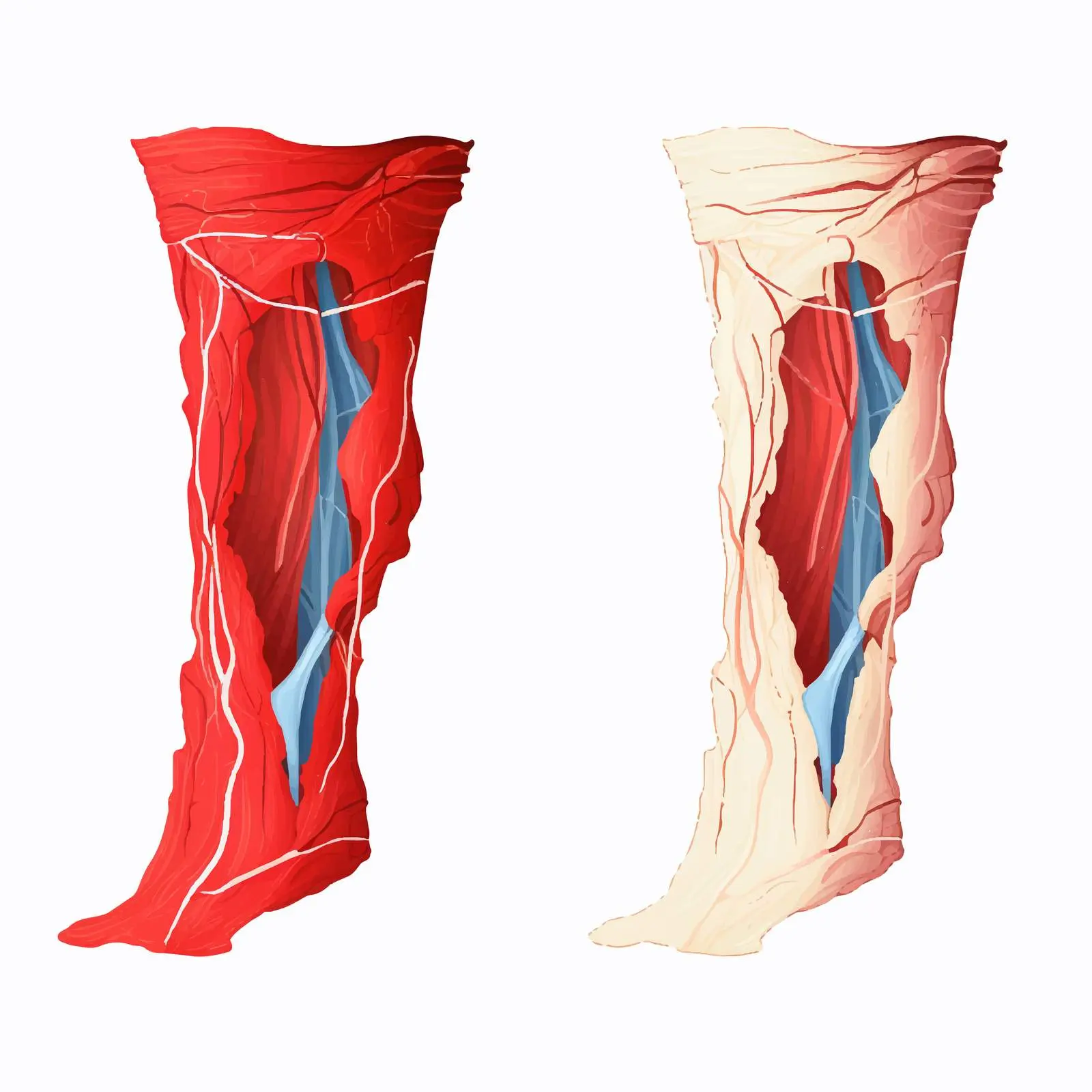 Healthy vs Ruptured Tendon Vector Comparison — free download from Dotvec