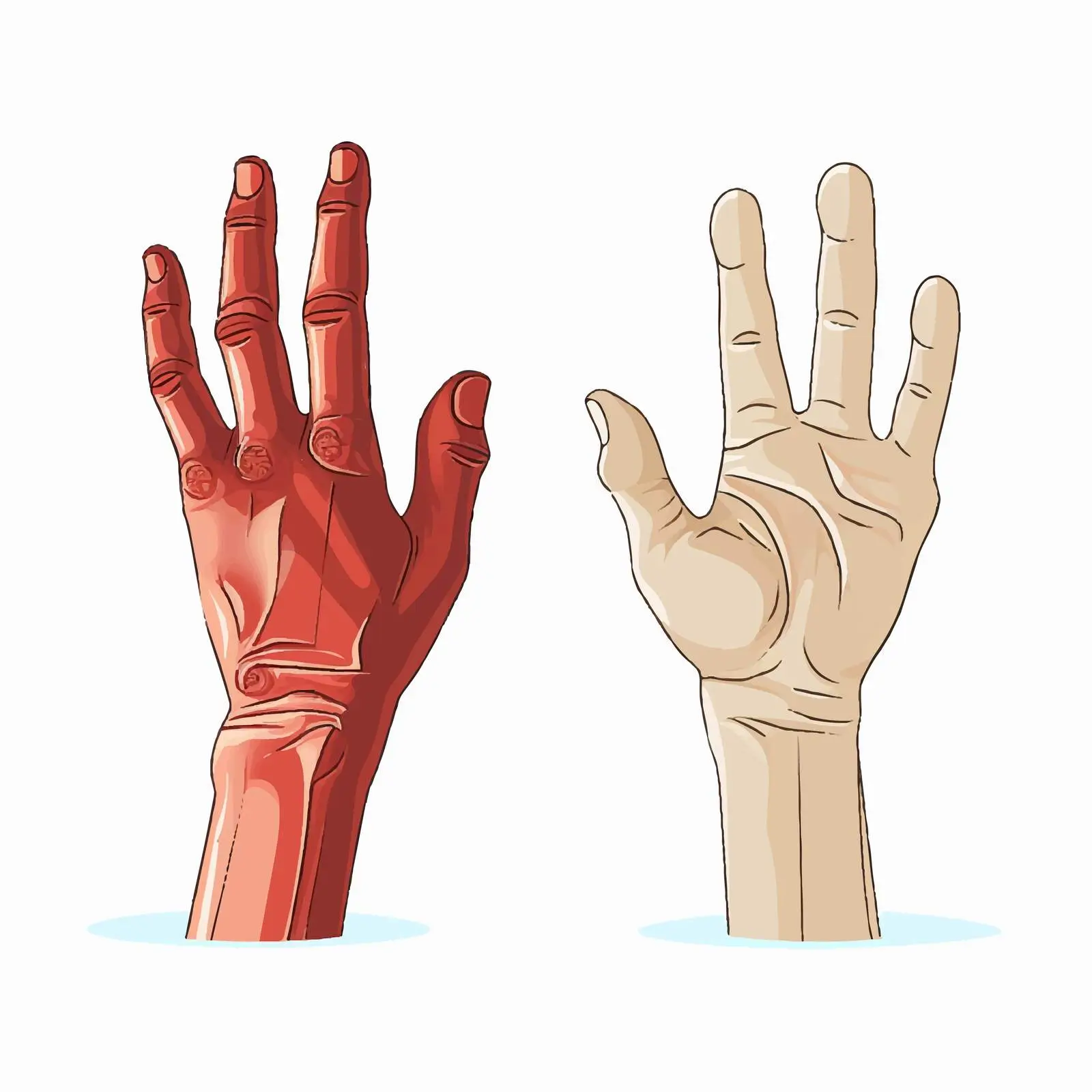 Normal Hand vs Affected Hand Comparison Vector — free download from Dotvec