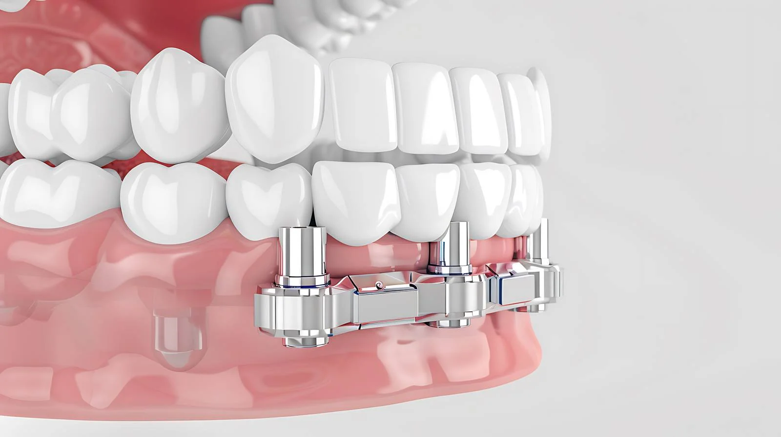 Advanced Dental Expander Treatment — free download from Dotvec