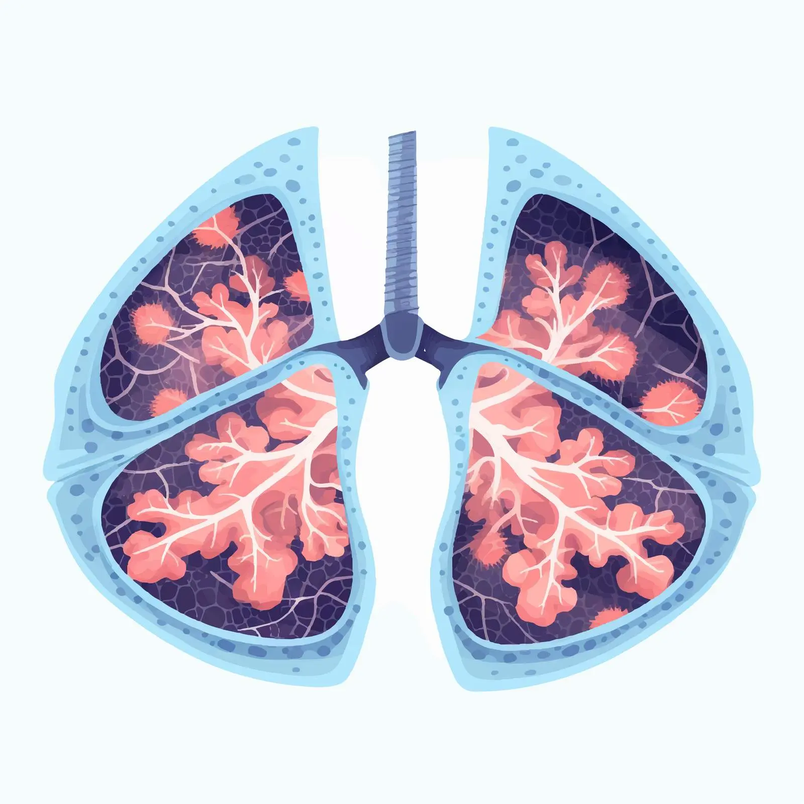 Asbestosis Diagram in Human Lungs Illustration – free lungs image from Dotvec