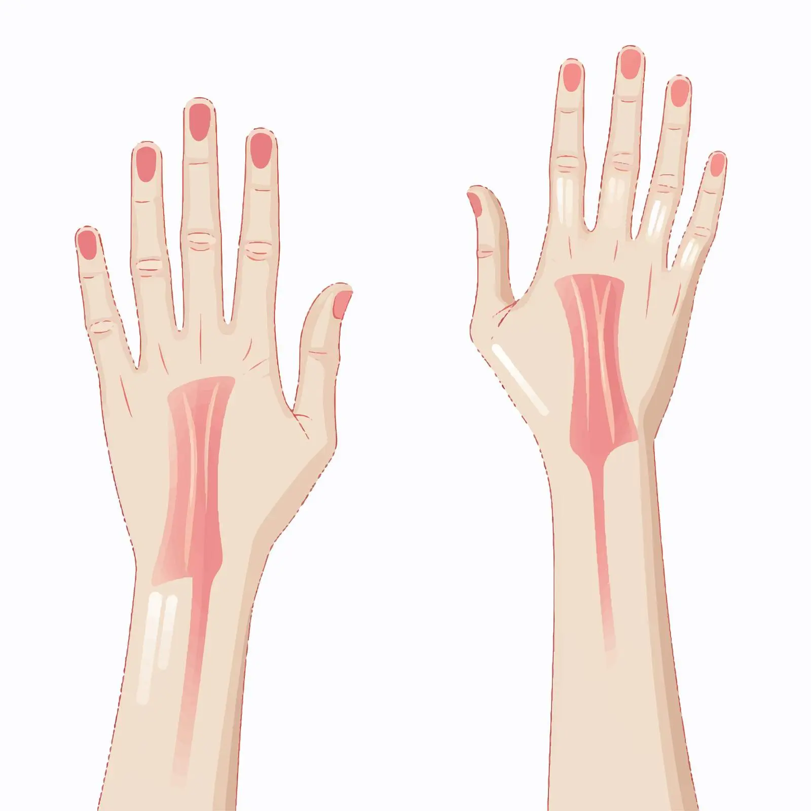 Normal and Mallet Finger Conditions Diagram — free download from Dotvec