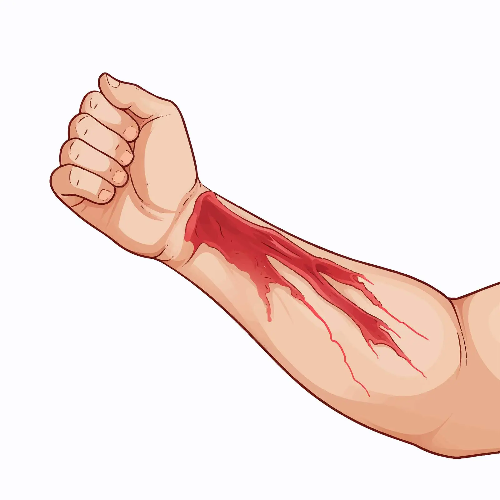 Elbow Bursa Inflammation Vector Illustration – free inflammation image from Dotvec