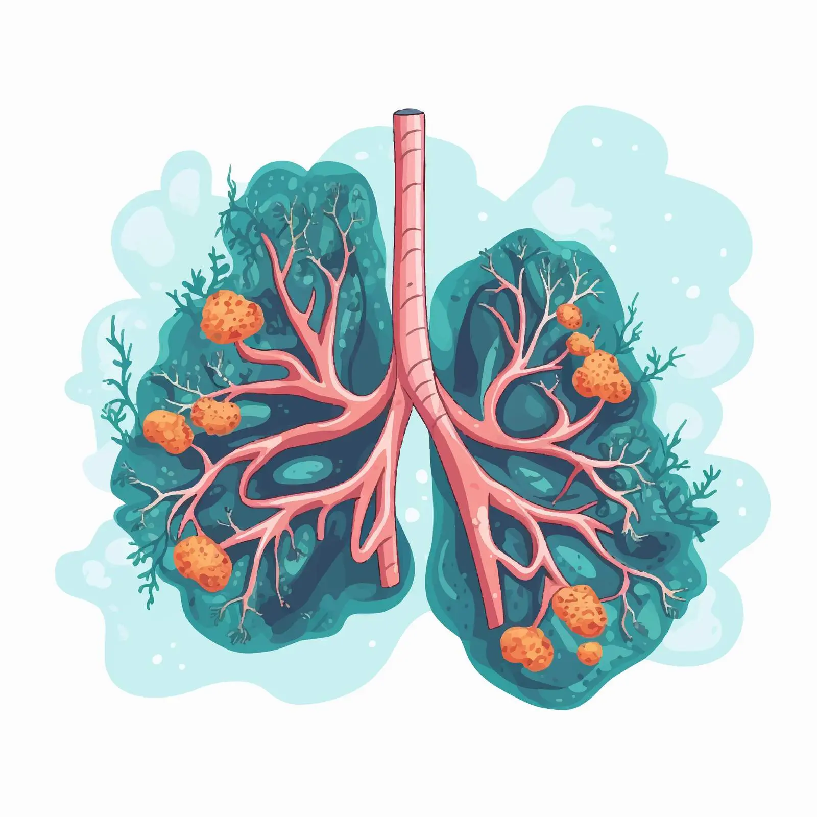 Tuberculosis Infection Lung Vector Illustration – free microbiology image from Dotvec