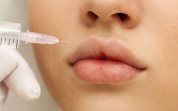Preenchimento labial em adolescentes acende alerta entre dermatologistas