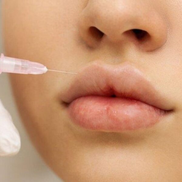 Preenchimento labial em adolescentes acende alerta entre dermatologistas