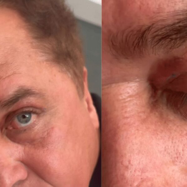 Poliana Rocha mostra resultado de cirurgia estética de Leonardo