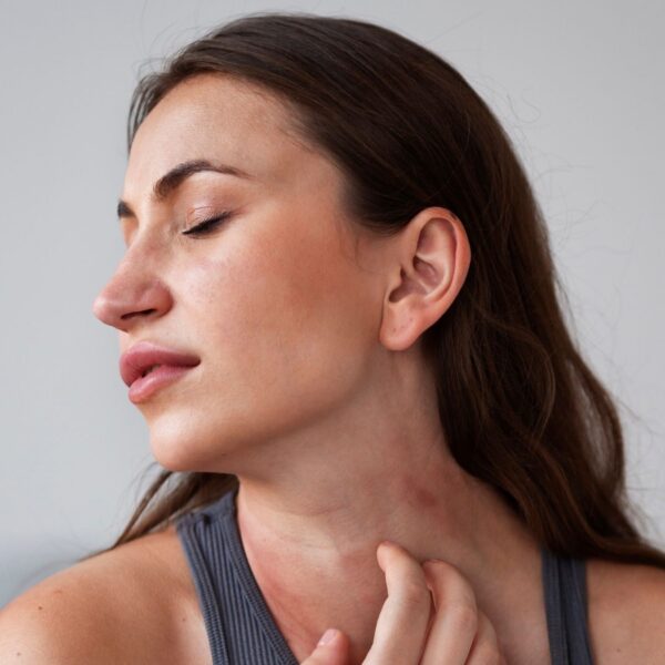 Acne adulta ou rosácea? Entenda as diferenças e por que o diagnóstico correto faz toda a diferença