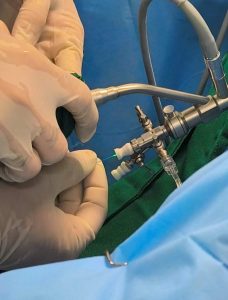 HRMS inova com cirurgias renais a laser no SUS, oferecendo segurança e modernidade