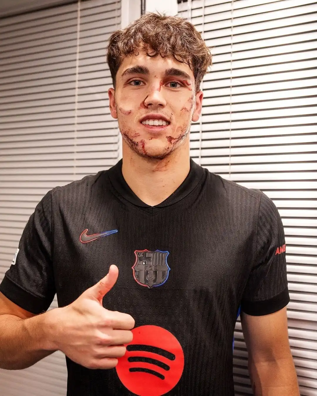 nxnoticias.com-cubarsi-jugador-del-barcelona-sufre-una-entrada-brutal-asi-quedo-su-rostro
