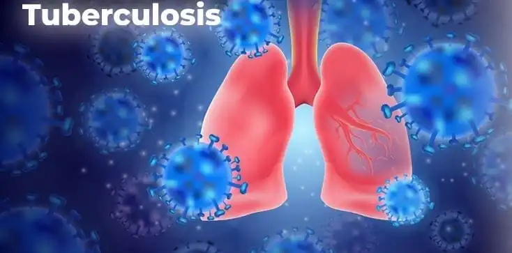 nxnoticias.com-tuberculosis-todavia-constituye-una-crisis-de-salud-publica-oms