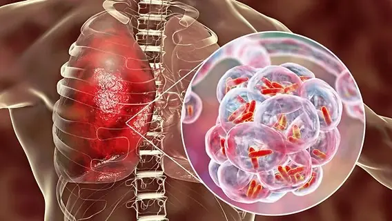 nxnoticias.com-rebasan-4-mil-casos-de-tuberculosis-en-mexico