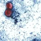 brote de ciclosporosis.