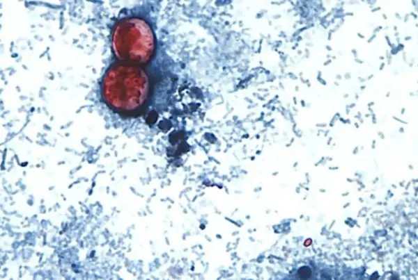 brote de ciclosporosis.