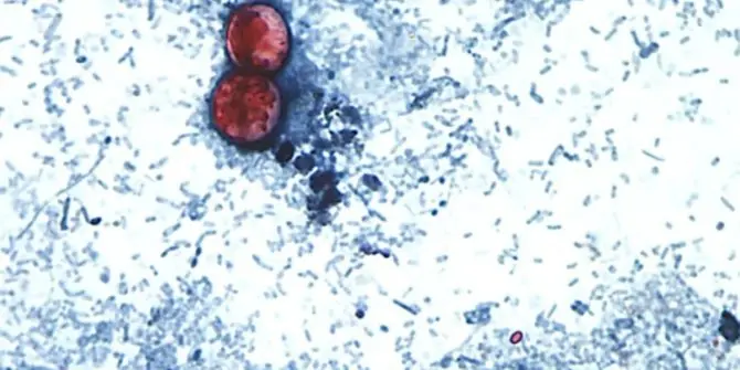 brote de ciclosporosis.
