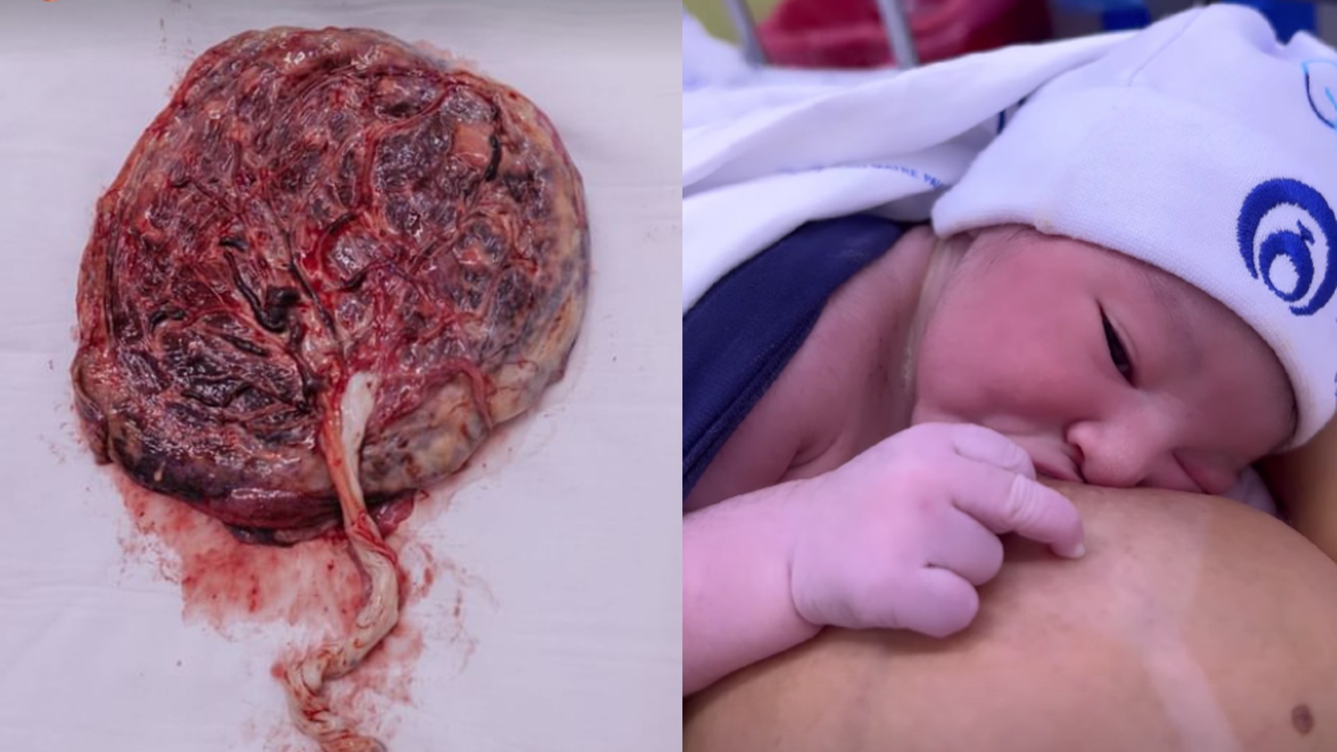 Placenta e Gabriel, primeiro filho de Fernanda Lacerda, Mendigata do Pânico