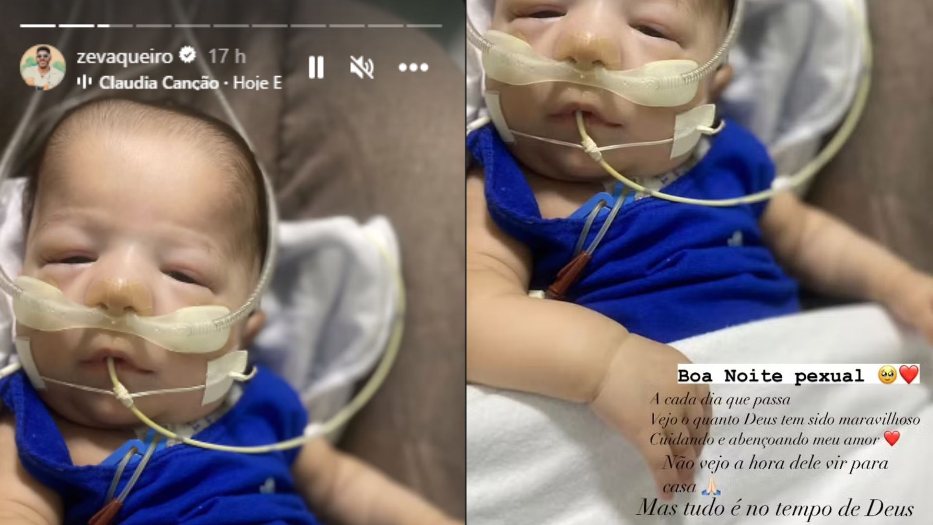 Stories de Z&eacute; Vaqueiro mostrando Arthur, seu filho com Ingra Soares que &eacute; diagnosticado com S&iacute;ndrome de Patau