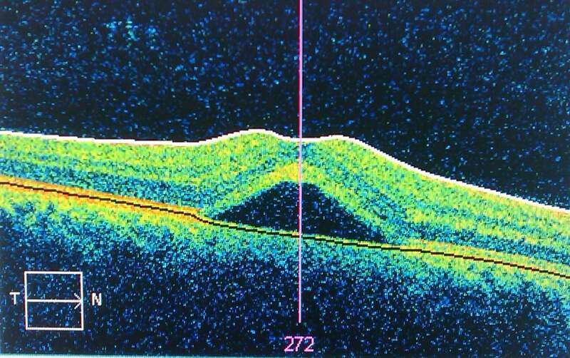 This an occurance of central serous retinopathy in my retina, imaged using optical coherence tomography with a Zeiss Visante OCT machine. Unfortunately, the software does not allow easy export of the data, so this is a cameraphone picture of the
