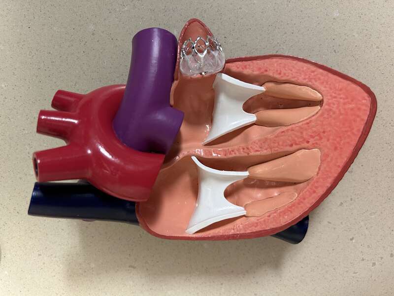 The mesh occludes the left atrial appendage and the wire stent helps to keep the device in place.
